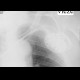 Outline of scapula, shoulder blade, mimic of pneumothorax: X-ray - Plain radiograph